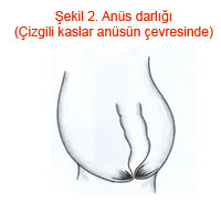 Anüs darlığı (Çizgili kaslar anüsün çevresinde)