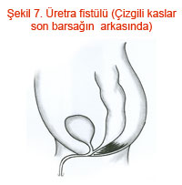Üretra fistülü (Çizgili kaslar son barsağın arkasında)