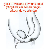 Mesane boynuna fistül  (Çizgili kaslar son barsağın arkasında ve altında)