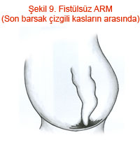 Fistülsüz ARM (Son barsak çizgili kasların arasında)