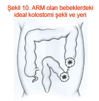 ARM olan bebeklerdeki ideal kolostomi şekli ve yeri