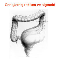 Genişlemiş Rektum ve Sigmoid