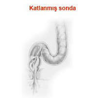 Katlanmış Sonda