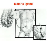 Malone İşlemi